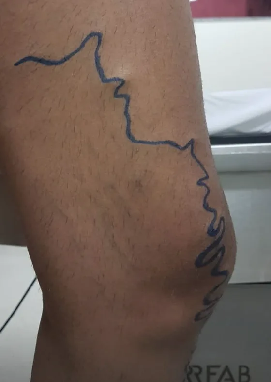 Antes: trajeto da veia safena marcado antes da cirurgia